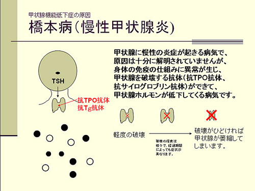 橋本病